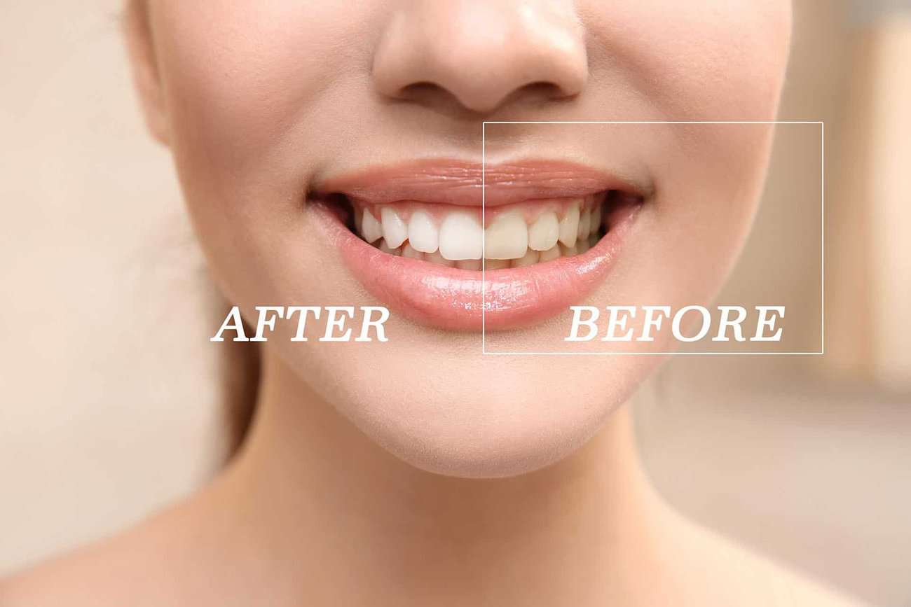 How Can You Maintain a Consistent Smile Shade with Crowns Nottingham?