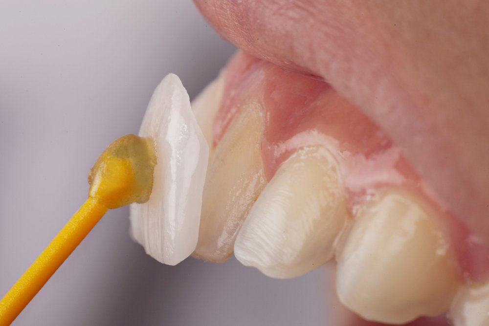 Dental Veneers: Achieving a Flawless Look Nottingham