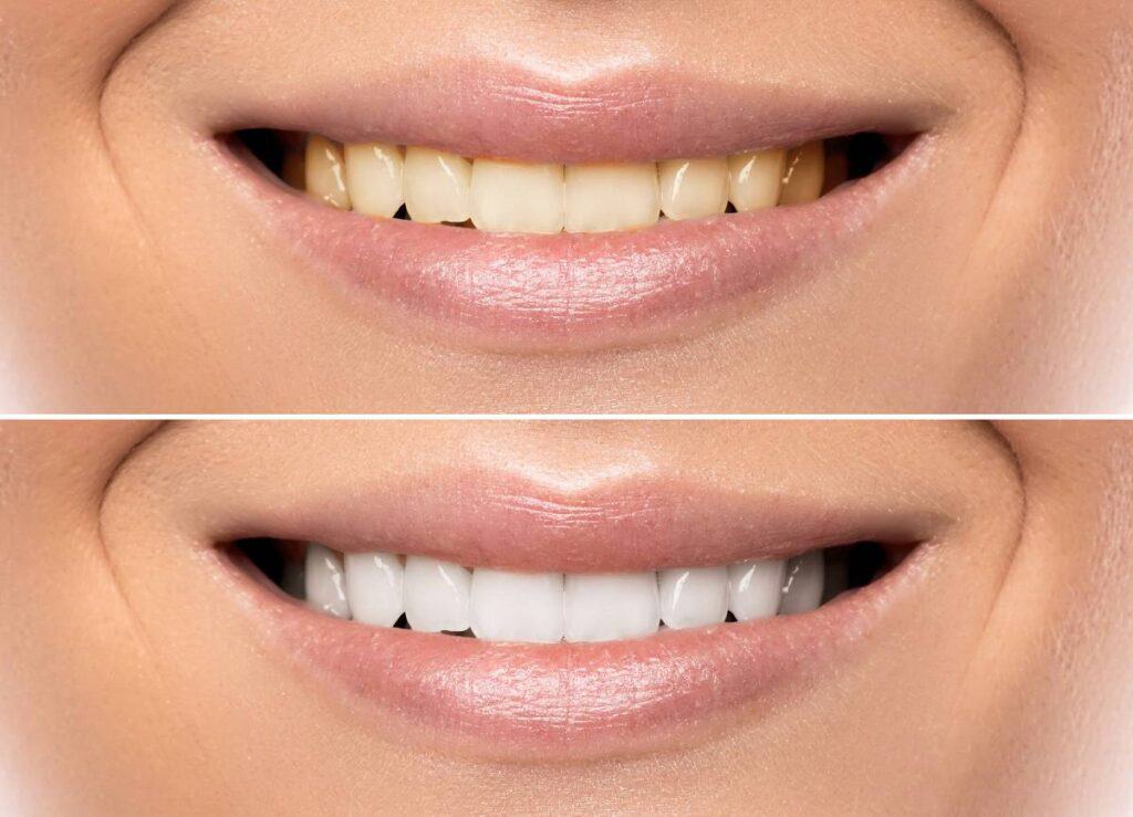 How Does Gum Disease Progress if Left Untreated Nottingham?