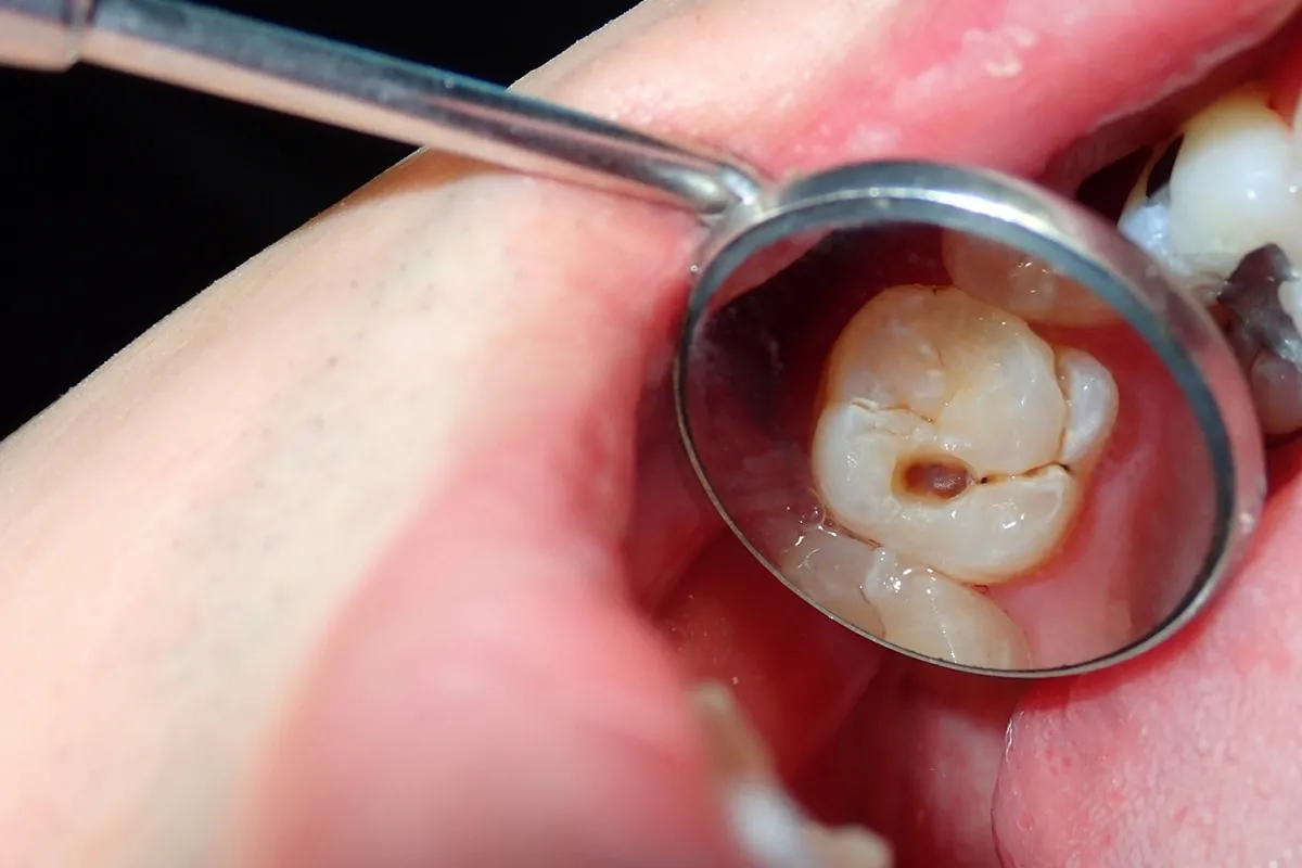 Why Do Teeth Crack? Common Causes to Know Nottingham