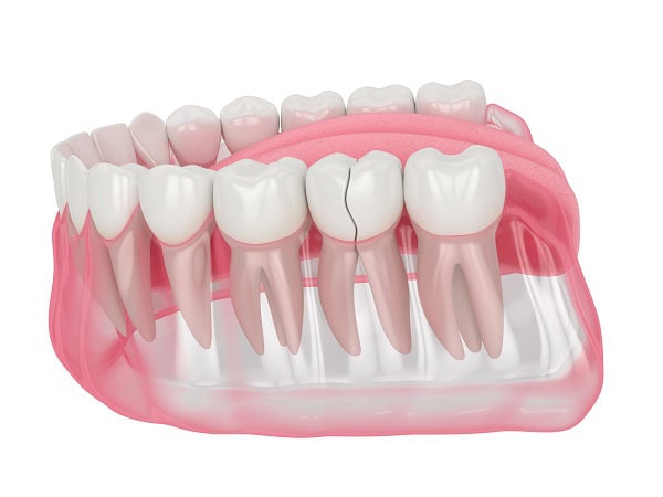 How Can You Manage Pain and Discomfort After a Root Canal Nottingham?