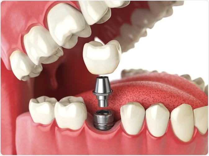 How Do I Decide Which Tooth Replacement Is Right for Me Nottingham?