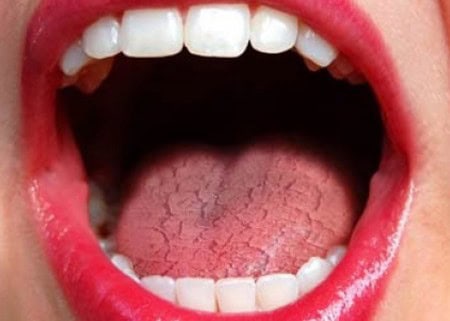 Common Causes of Dry Mouth (Xerostomia) Nottingham