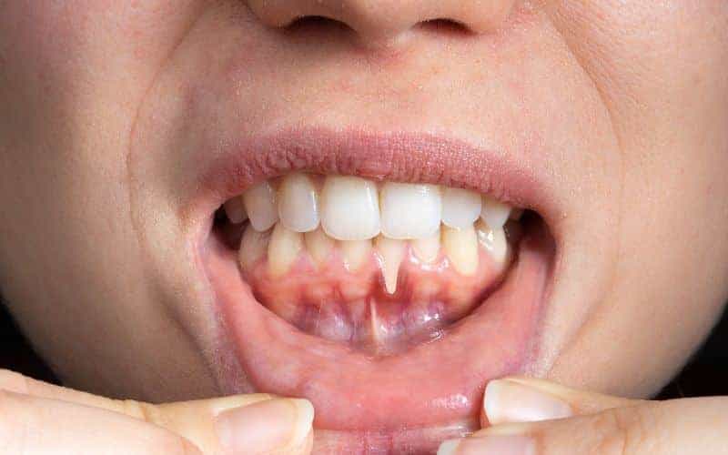 How Can Gum Disease Be Prevented Nottingham?