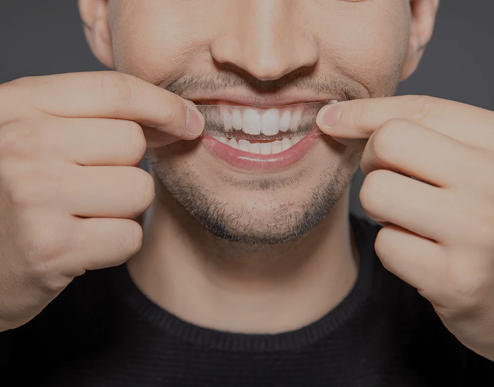 What to Consider Before Choosing a Teeth Whitening Option Nottingham
