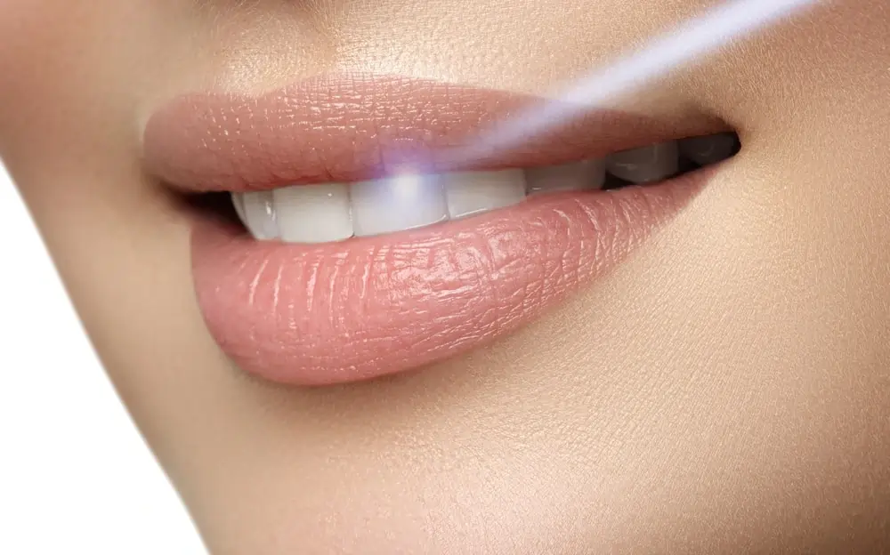 How Quickly Will You See Results After Laser Teeth Whitening Nottingham?