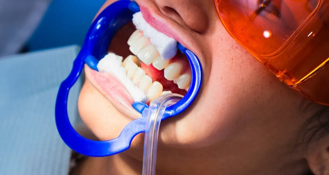 How Teeth Whitening Treatments Actually Work on Your Enamel Nottingham
