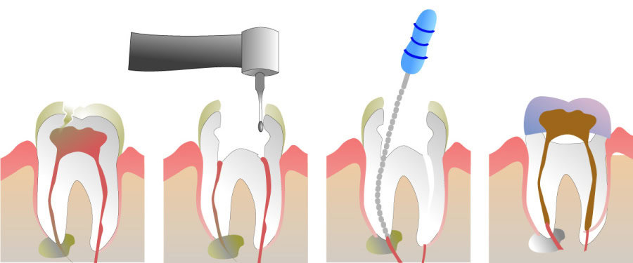 How Do You Properly Care for Your Teeth After a Root Canal Nottingham