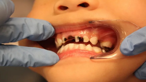 Which Foods and Drinks Cause the Most Damage to Young Smiles Nottingham?