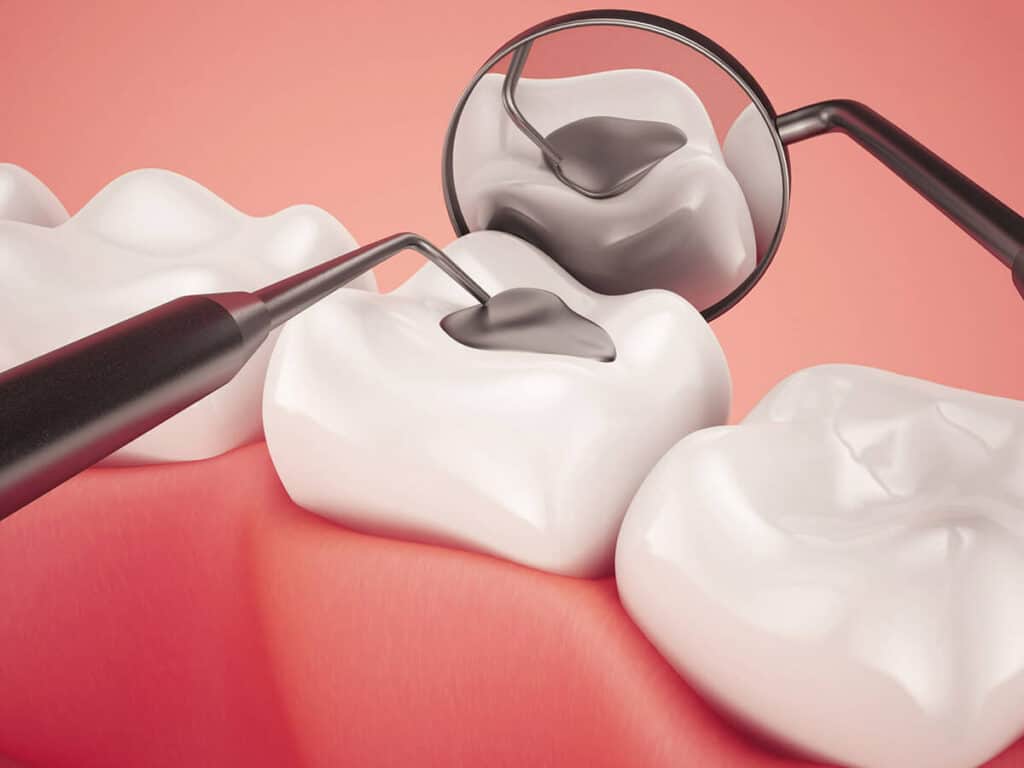 Fighting Cavities and Plaque Buildup Nottingham