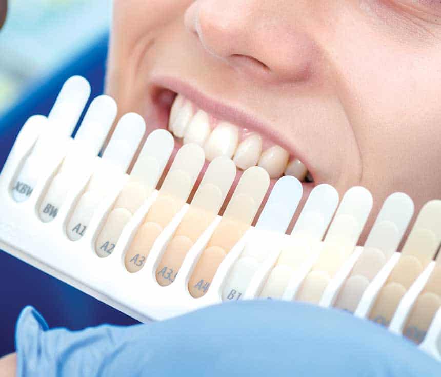 How Much Does One Laser Teeth Whitening Session Cost Nottingham?