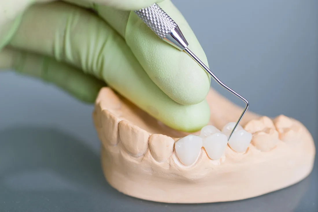 Do Braces Take Years to Show Results Nottingham
