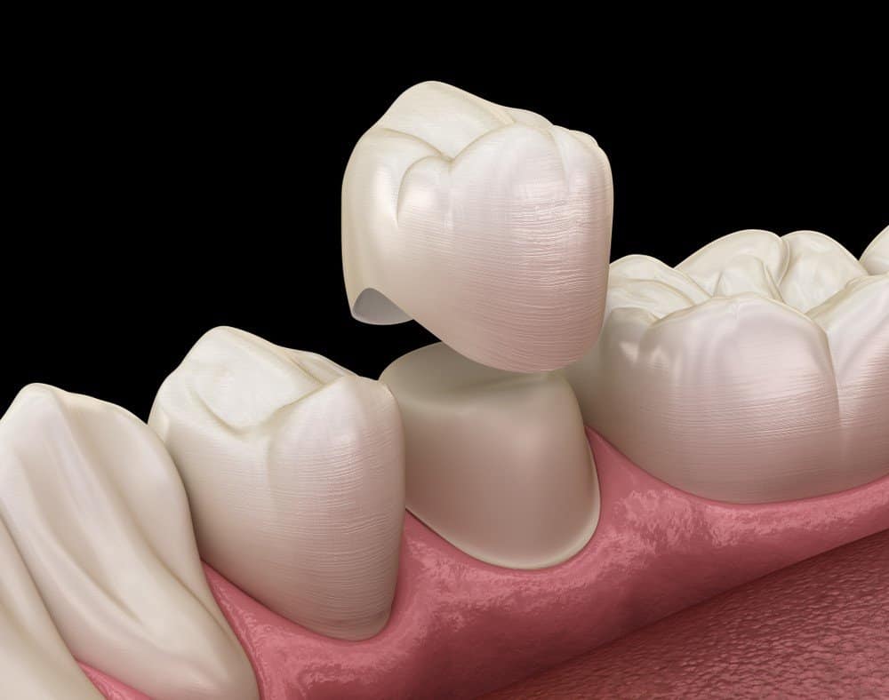 What Daily Habits Help Protect Your Dental Crowns Nottingham?