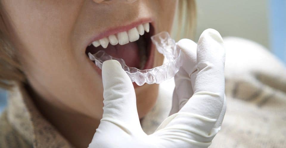 Why Bleaching Trays Require More Time Nottingham